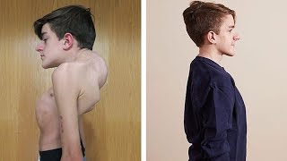 John Sarconas Testimonial  Overcoming Severe Scoliosis and Kyphosis [upl. by Naam]