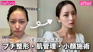 【おすすめ美容施術】本当に効果のあったもの、なかったもの全て話します！美肌・プチ整形・リフトアップ施術 [upl. by Lohman]