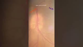 Fundus examination on 90  Disc Edema [upl. by Eicats522]