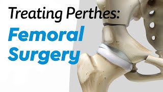 Femoral Surgery for Treating Perthes Disease in Children [upl. by Onirefes109]