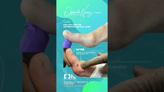 Hallux Limitus  Arthritic big toe joint [upl. by Laval994]