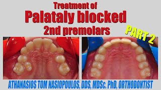 Treatment of Palataly Blocked 2nd Premolars Part 2  Athanasios Tom Nasiopoulos [upl. by Yeslaehc]