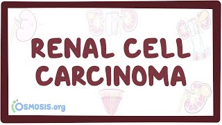 Renal cell carcinoma  an Osmosis Preview [upl. by Kapor240]