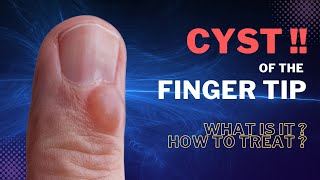 Finger Mucous Cyst  Learn to treat in 3 minutes [upl. by Oswin]