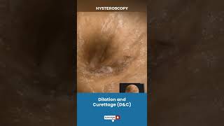 बच्चेदानी Uterus का Dilation और Curettage  Procedure for removing unwanted tissue in uterus [upl. by Johnna417]