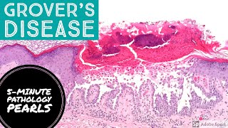 Grovers Disease Transient Acantholytic Dermatosis 5Minute Pathology Pearls [upl. by Rame235]