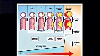 Chronic Stable Angina  Medical Presentation [upl. by Mateya]