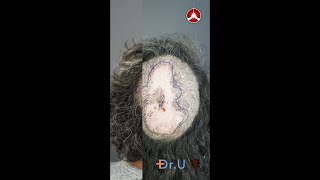 Folliculitis Decalvans Surgical Excision Before and After  Dr Sanusi Umar [upl. by Riella]