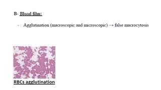 cold autoimmune hemolytic anemia [upl. by Aurel]