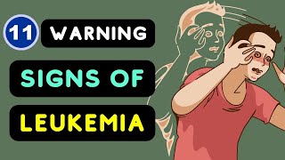 Leukemia Signs and Symptoms Top 11 Warning Signs of Leukemia You Should be Aware of [upl. by Akvir]