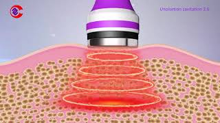 How Ultrasonic Cavitation Work How Ultrasonic Cavitation Remove Fat What Is Cavitation Machine [upl. by Pesvoh468]