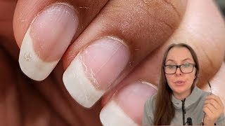 Dry and peeling nails despite of using oil [upl. by Ellie]