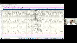 EEG SPOTTERS Dr SUJITH [upl. by Anirual]