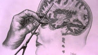 The Most TWISTED Medical Procedure in History  The Lobotomy [upl. by Akselaw110]