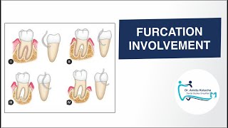 How to record FURCATION INVOLVEMENT GLICKMANS CLASSIFICATION RADIOGRAPHIC FINDINGS DR ANKITA [upl. by Ahsila]