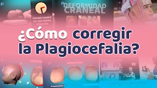 ¿Como corregir la plagiocefalia Plagiocefalia Argentina [upl. by Molohs]