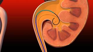 Ureteral Obstruction  Retrograde insertion of Resonance stent [upl. by Roux254]