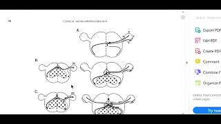 Kanski Clinical Ophthalmology Made Easy  Neuro 10 Chiasmal syndrome [upl. by Ilocin]