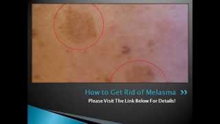 How to Get Rid of Melasma Naturally Permanently At Home  Melasma Treatment [upl. by Darice859]