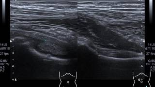 Synovitis of Right Hip Joint [upl. by Atnahs]