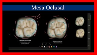 Morfología en digital primer molar superior Mesa Oclusal [upl. by Atsirhcal59]