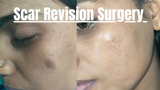 Scar revision surgery  follow up result after 9 month Result of scar revision surgery scar [upl. by Adali]