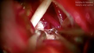 Hemifacial Spasm  Permanent Cure  MVDMicrovascular DecompressionFacial Nerve  Dr Mehul Baldha [upl. by Brok297]