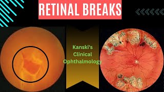 Retinal breaksKanskis clinical ophthalmology retinal tear retinal detachment subretinal fluid [upl. by Riada378]