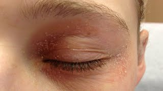 how to get rid of eczema on eyelids naturally [upl. by Amity]