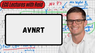 AV Nodal Reentry Tachycardia  Day 16 ECG Challenge [upl. by Amilah]