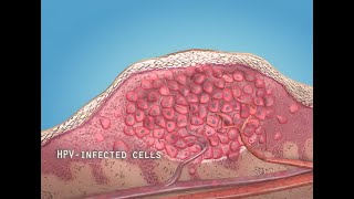 What are warts HPV  3D animation [upl. by Lehcim]