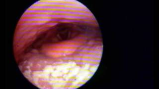 Sleep endoscopy wwwrussarebiz Clinica Sonno [upl. by Tyoh]