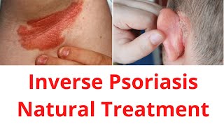 Inverse Psoriasis Treatment  Natural Healing [upl. by Lorianne]