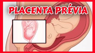 Comprendre le placenta previa [upl. by Hadnama324]