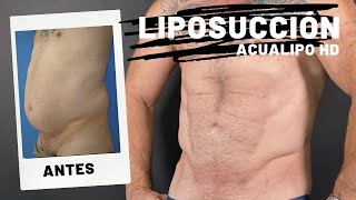 LIPOSUCCIÓN ABDOMEN Y FLANCOS EN HOMBRE MADURO CON DEFINICIÓN [upl. by Doniv]