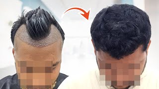 Case Study 6Month Hair Transplant Results 🧐  Hair Transplant Mumbai  New Roots [upl. by Circosta]