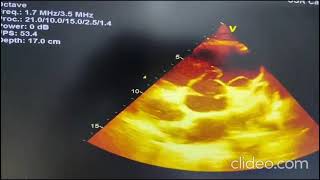 Ruptured Right Sinus of Valsalva Aneurysm RSOVA into RVOT [upl. by Dera]