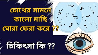 What are Floaters in eyes causes and treatment  Vitreous floaters eye eyefloaters eyeflashes [upl. by Demahom962]