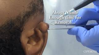 Right Ear Lobe Keloid  Removal Surgical [upl. by Emmerich]