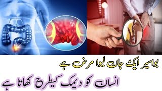 piles treatment without surgery  bawaseer ka ilaj  best hemorrhoid treatment  piles ka ilaj [upl. by Orpha]