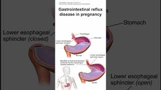 Gastrointestinal reflux disease in pregnancy [upl. by Anaeed]