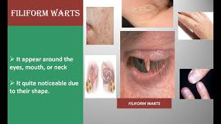 MEDICAL TREATMENTS OF DIFFERENT TYPE WARTS [upl. by Kimberley]