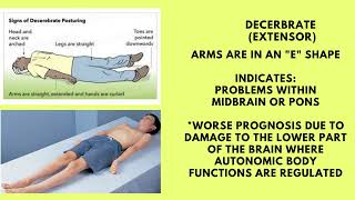 TBI Posturing Decerebrate vs Decorticate [upl. by Emsmus]