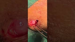 Lymphnode neck excision unedited  Lymphoma  Dr Hitesh Patel [upl. by Salman986]