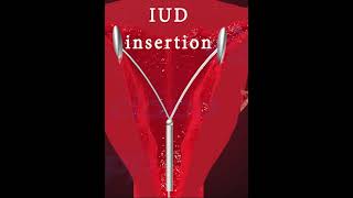 Understanding IUD Implantation A Comprehensive Guide to Preventing Pregnancy [upl. by Guimond]