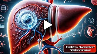 TACE  Transarterial chemoembolization  Chemotherapy  Cancer Treatment  Dr Gaurav Gangwani [upl. by Lister]