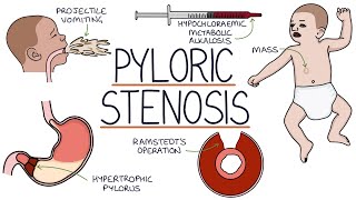 Understanding Pyloric Stenosis [upl. by Elgar]