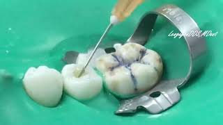 Endodontic procedure [upl. by Aihsinat]