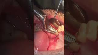 Extraction of upper right second molar roots [upl. by Reggis]