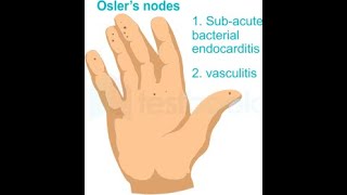 Oslers Node  Definition Causes Disease Association Clinical significance Differential diagnosi [upl. by Samohtnhoj]